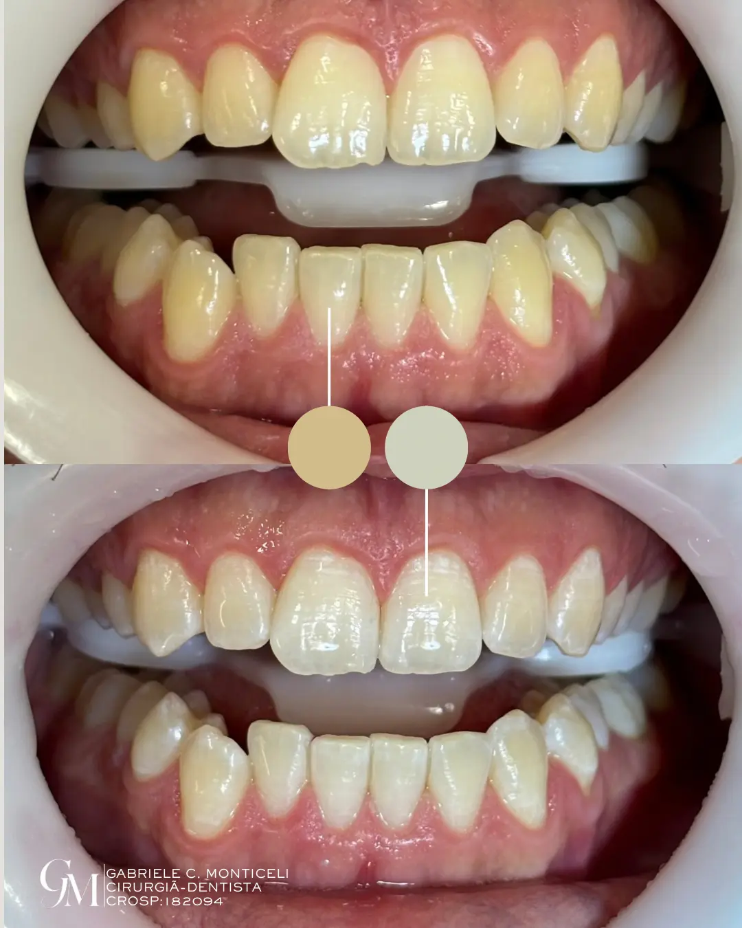 Caso clínico real autorizado: comparação antes e depois de clareamento dental